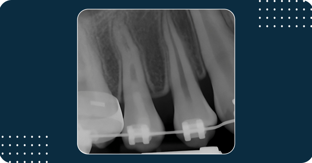 PULPAL REGENERATION OF TWO NECROTIC PREMOLARS WITH DENS EVAGINATUS_A CASE SERIES